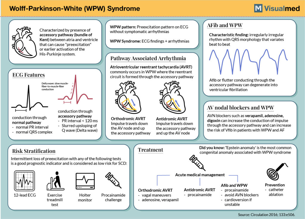 Wolf-Parkinson-White (WPW) Syndrome: Infographic - Visualmed