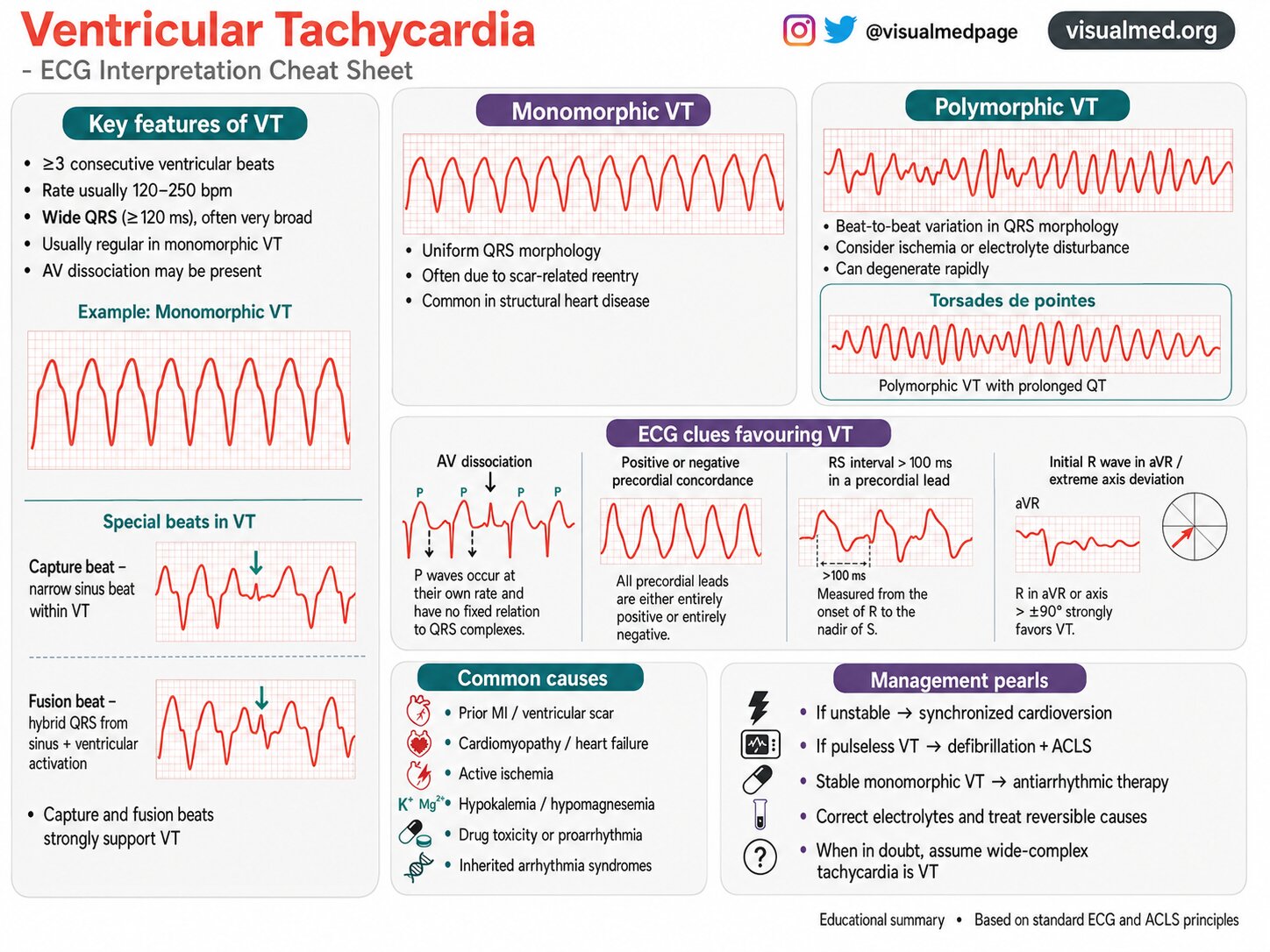 ventricular tachycardia vt cheat sheet